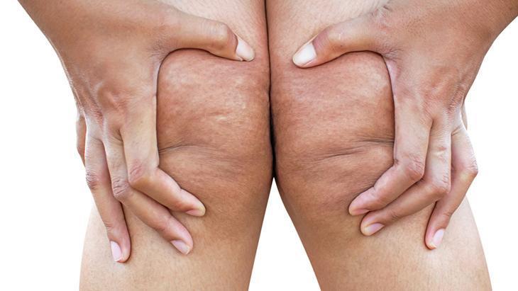 lipodem kadinlarin sessiz cigligi neden kilo veremiyorum diyenler icin cevap mDpGzpLA.jpg